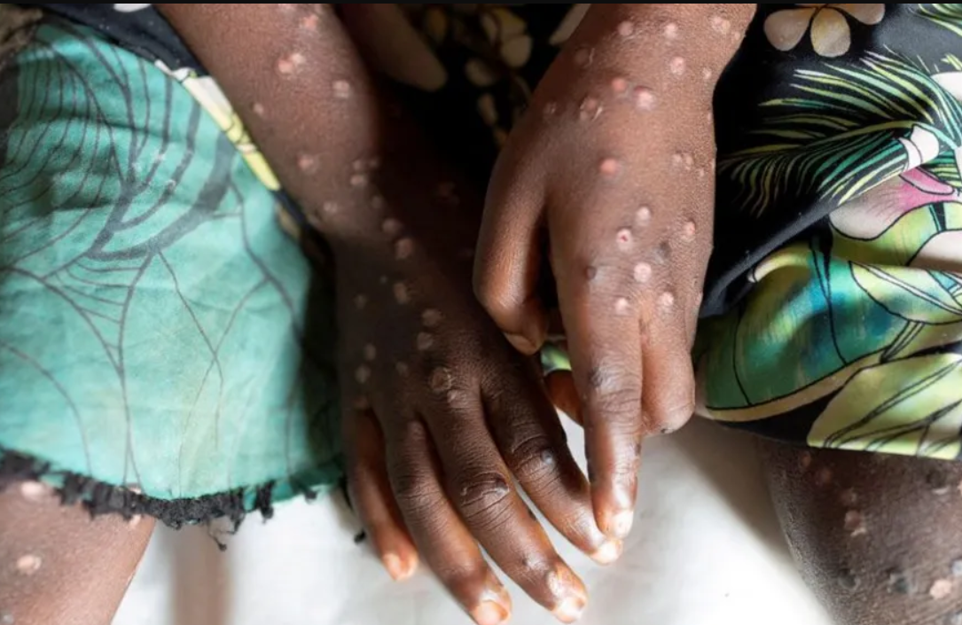 Africa Declares Public Health Emergency Due to Mpox Outbreak