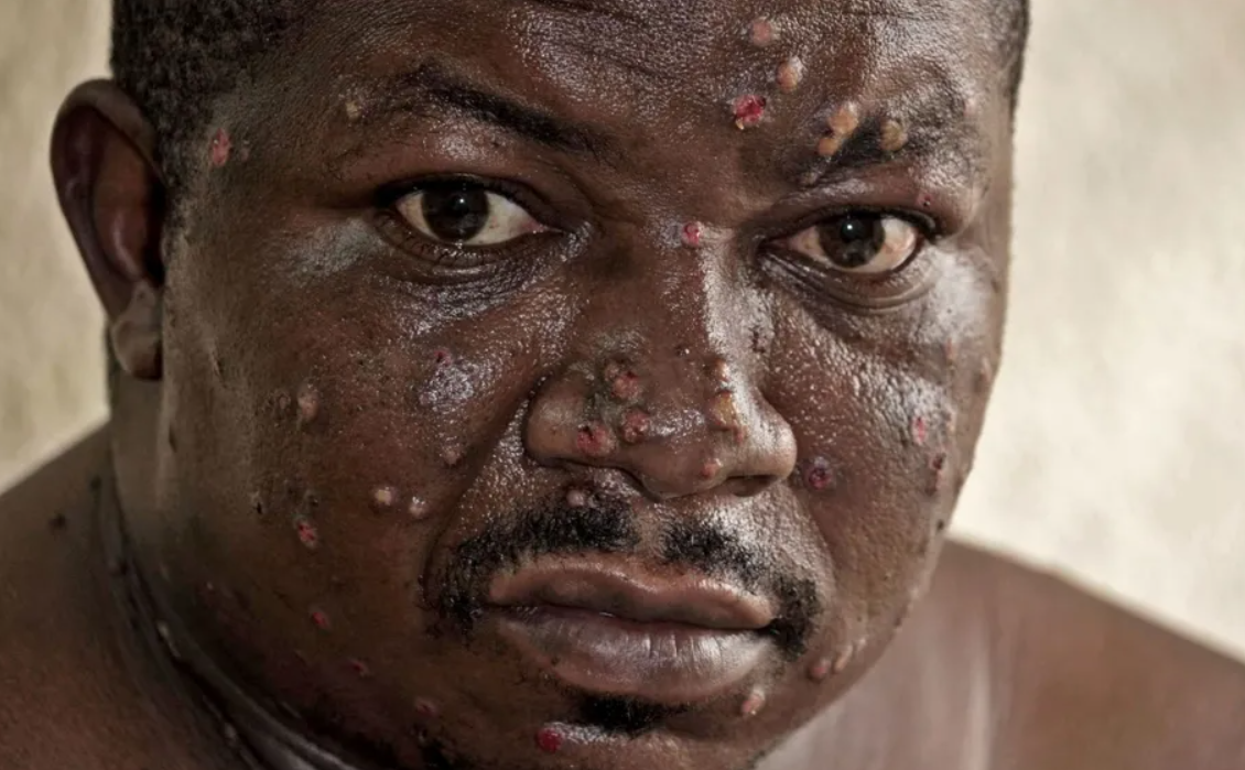 Mpox Left My Throat in Excruciating Pain, Making Sleep Impossible