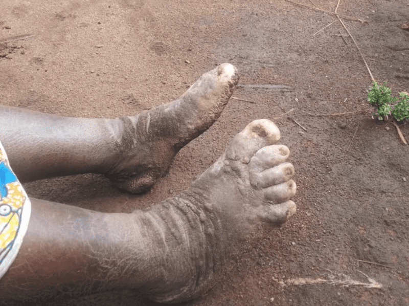 Rare Type Of Elephantiasis In Uganda.